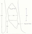 Diagram of the scarring on the paperbark